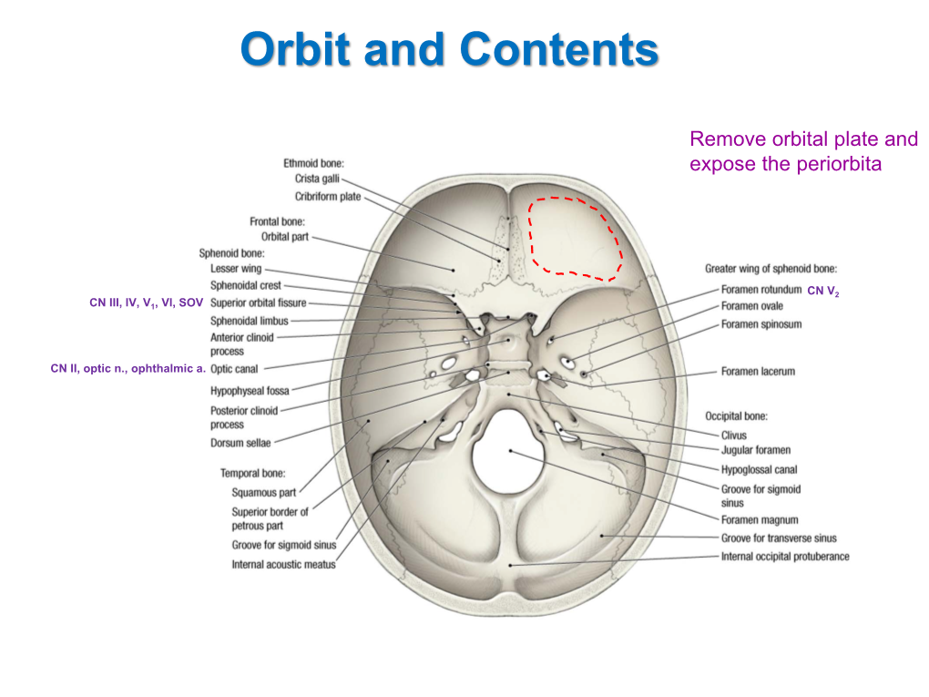 Abducens Nerve Lesion • Right LR Is Disabled