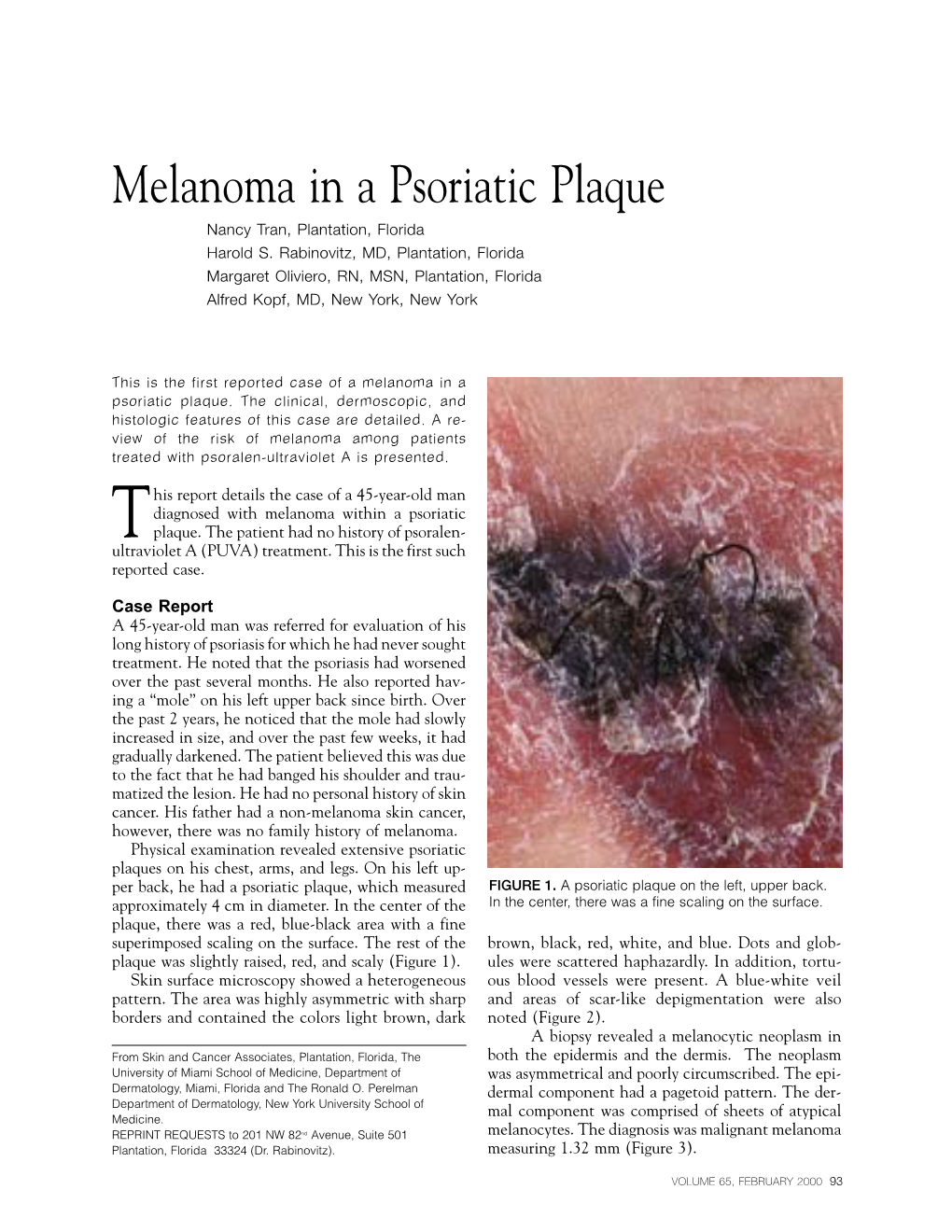 Melanoma in a Psoriatic Plaque Nancy Tran, Plantation, Florida Harold S