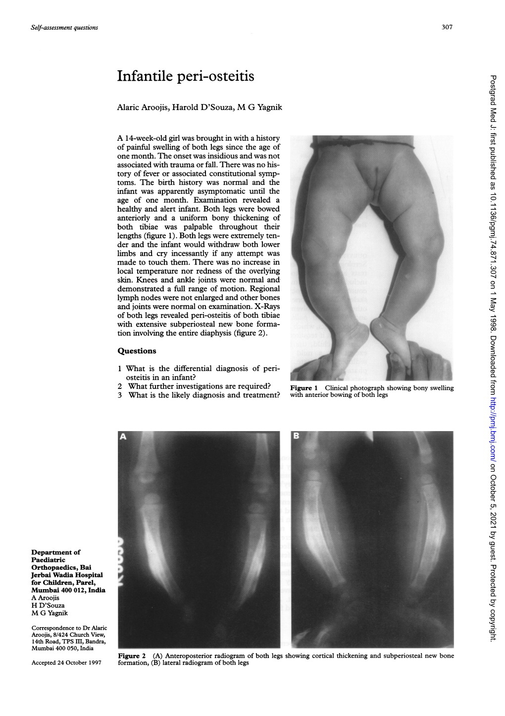 Infantile Peri-Osteitis Postgrad Med J: First Published As 10.1136/Pgmj.74.871.307 on 1 May 1998