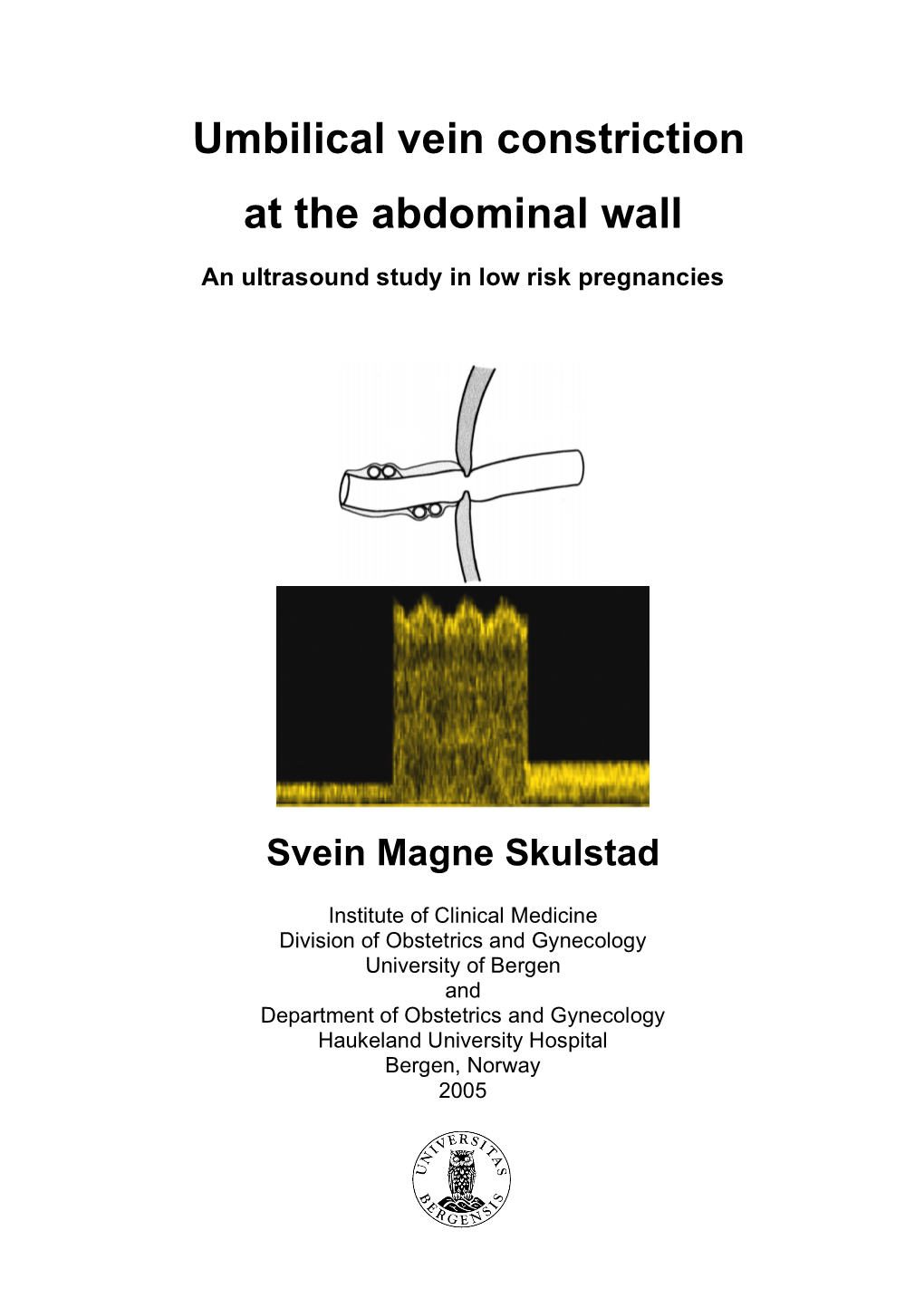 Umbilical Vein Constriction at the Abdominal Wall