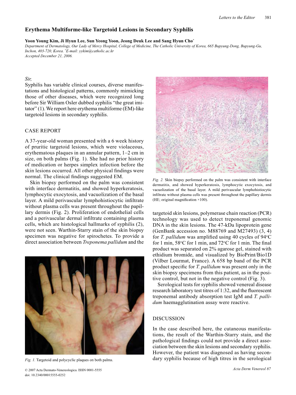 Erythema Multiforme-Like Targetoid Lesions in Secondary Syphilis