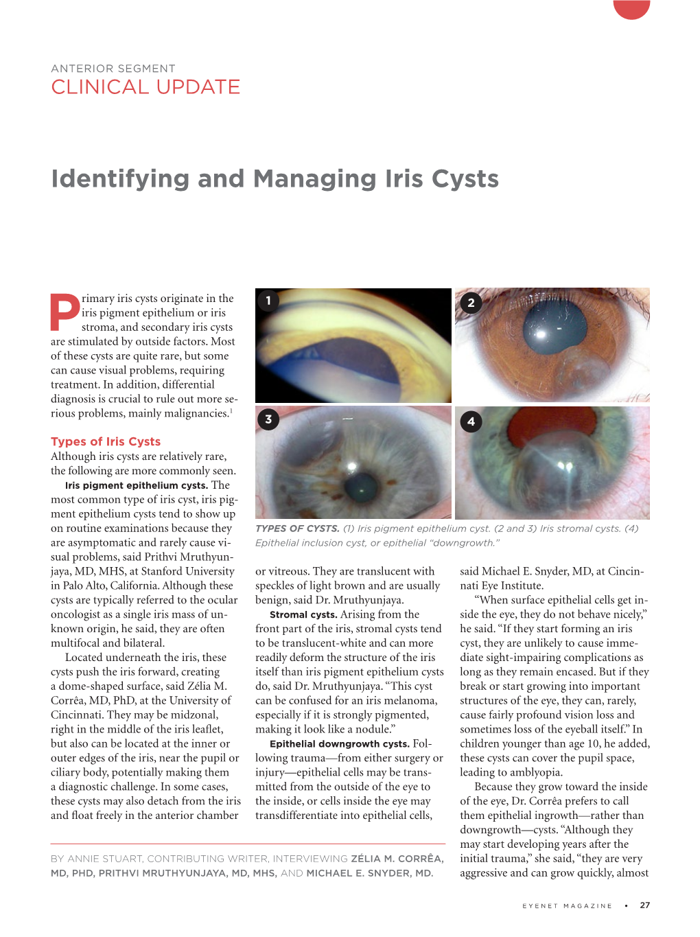 Identifying and Managing Iris Cysts