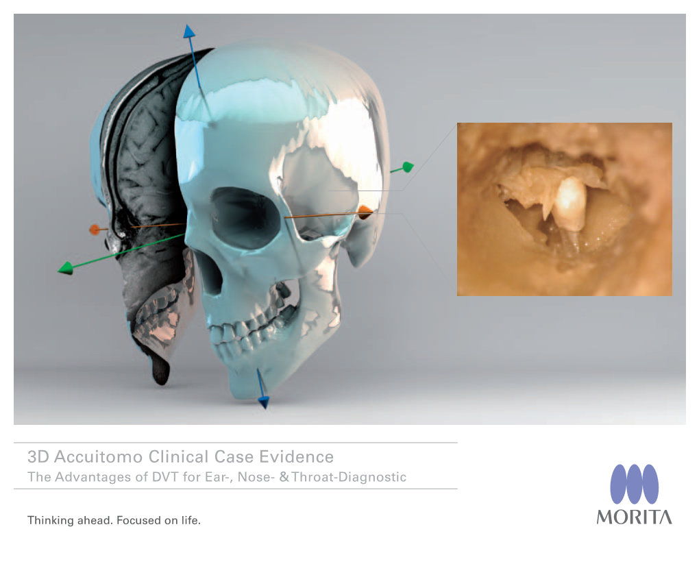 3D Accuitomo Clinical Case Evidence the Advantages of DVT for Ear-, Nose- & Throat-Diagnostic
