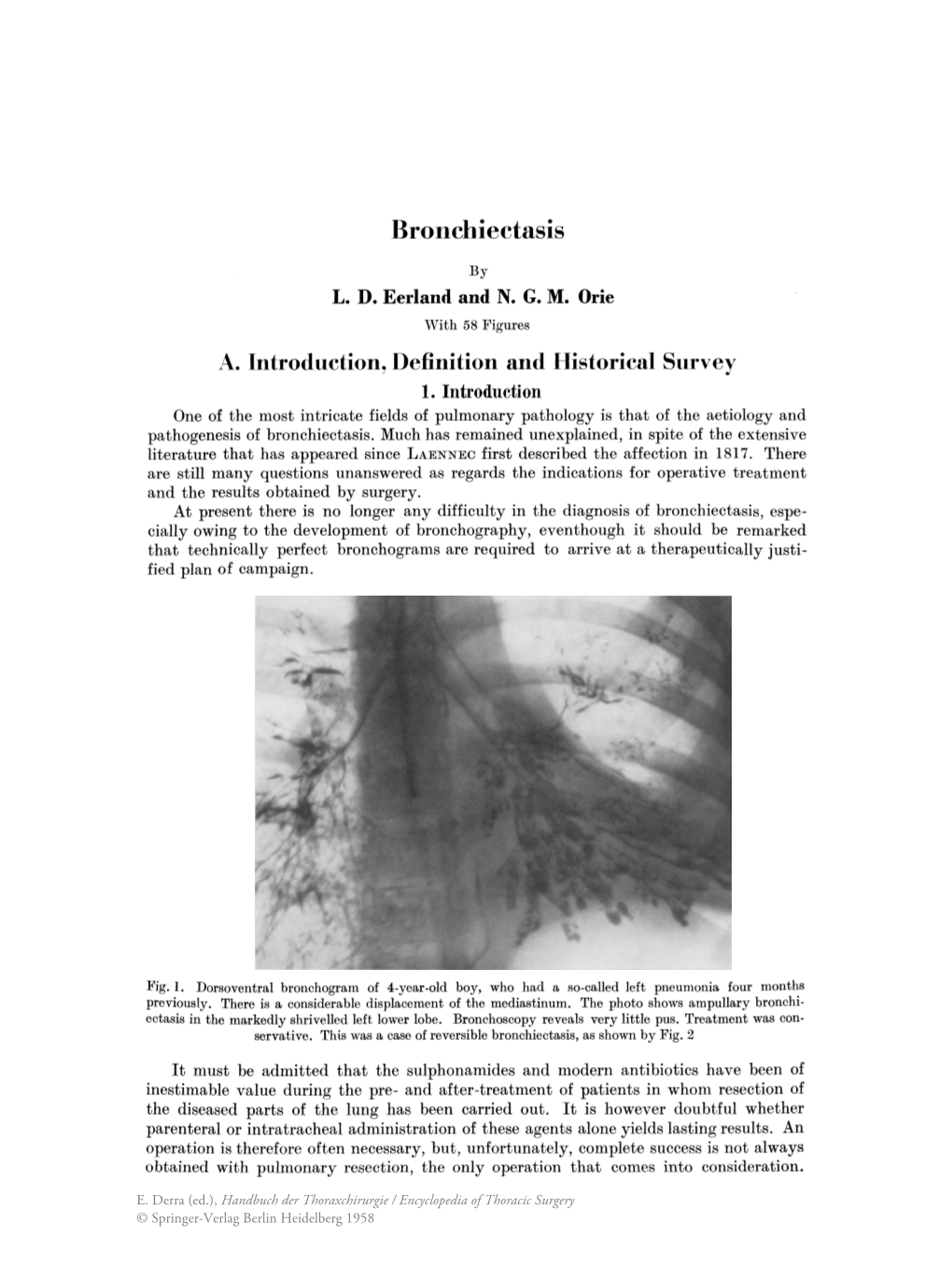 Bronchiectasis