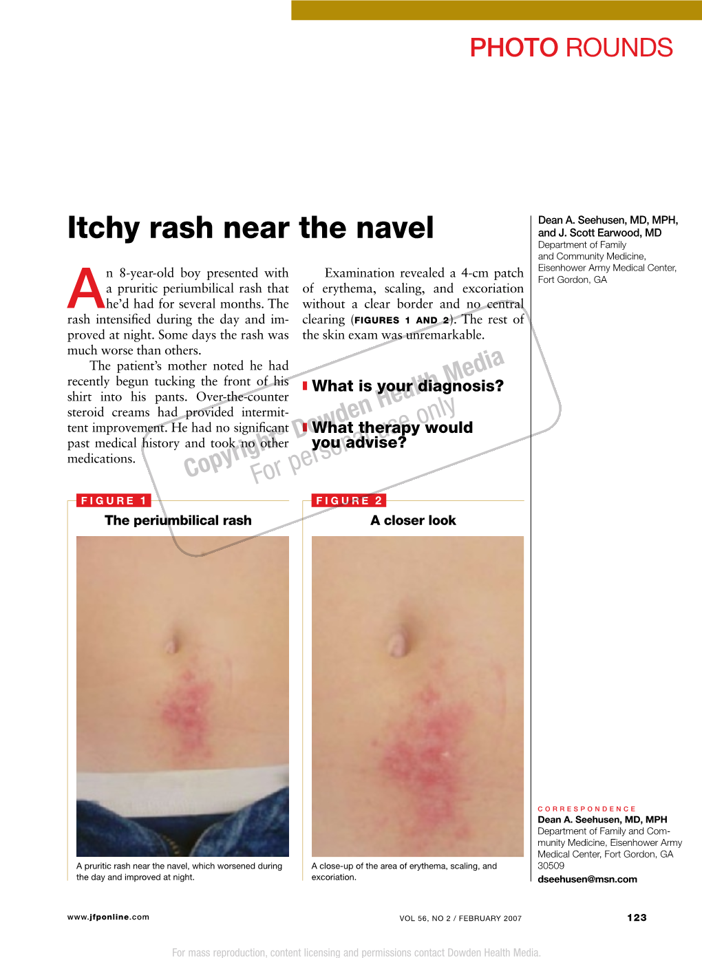 Itchy Rash Near the Navel and J