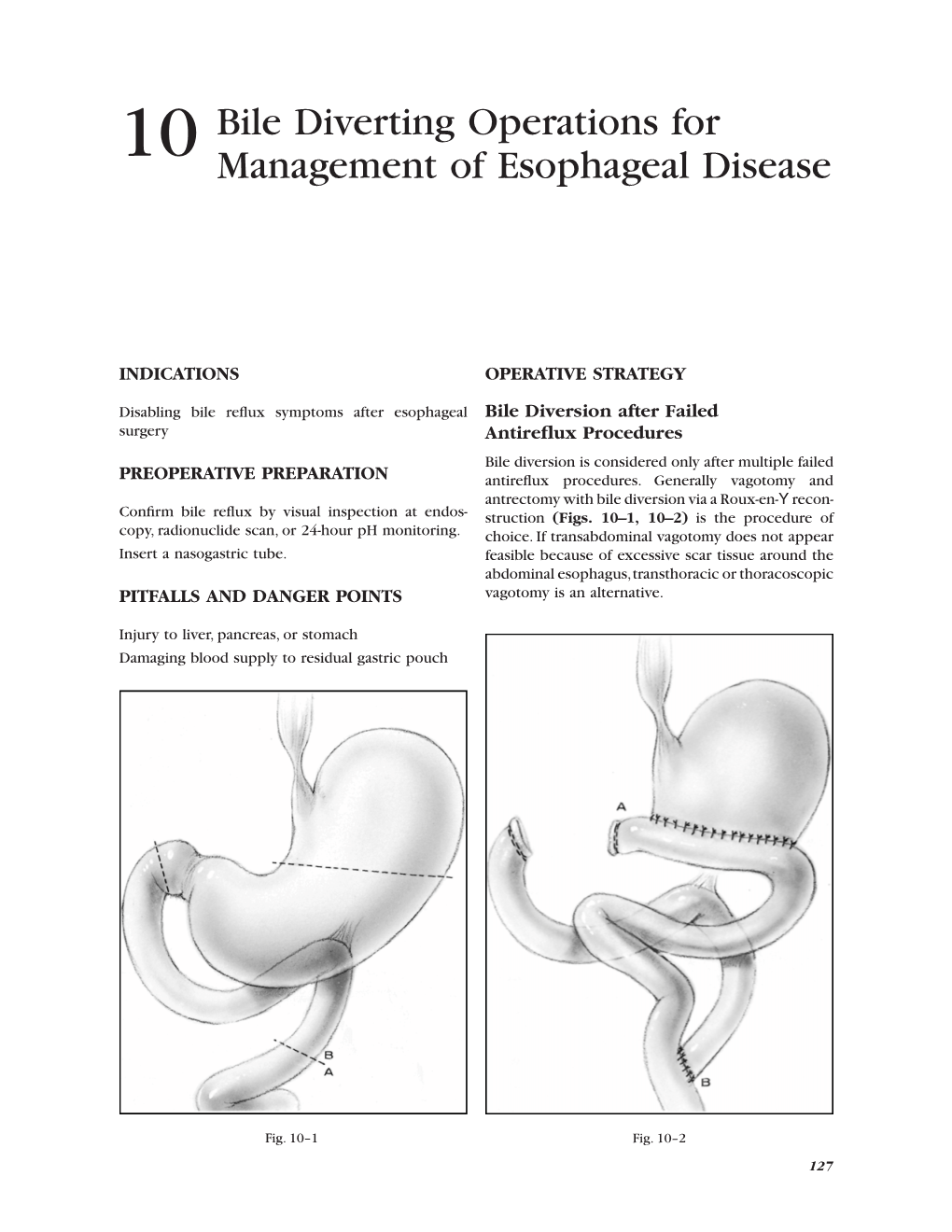 10 Bile Diverting Operations for Management of Esophageal Disease