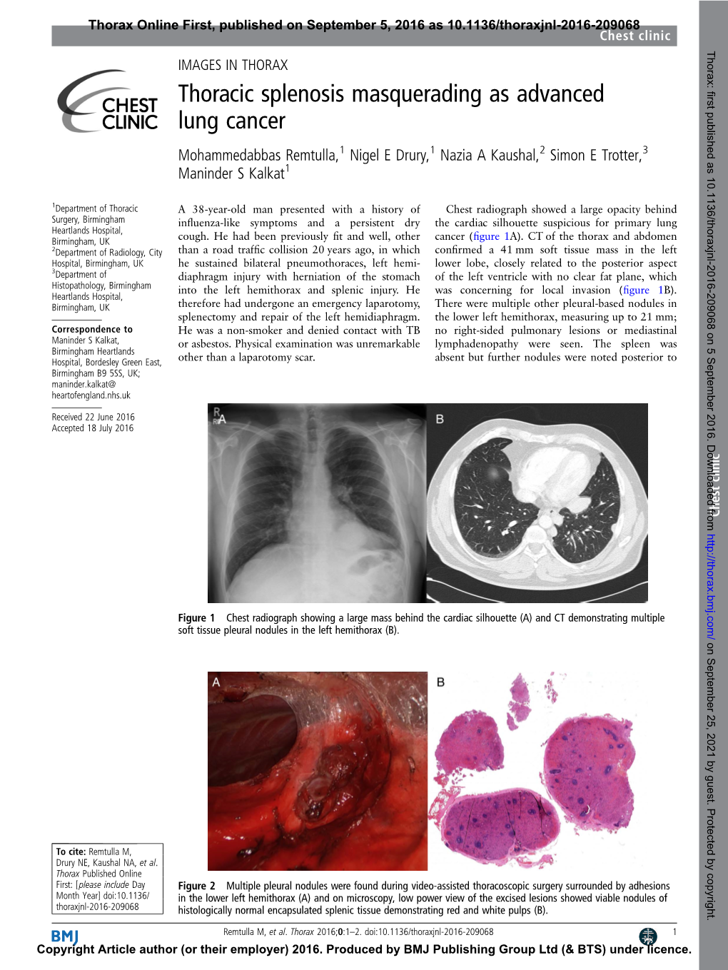 Thoracic Splenosis Masquerading As Advanced Lung Cancer
