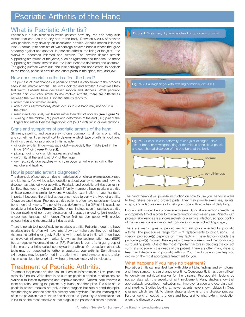 Psoriatic Arthritis of the Hand What Is Psoriatic Arthritis? Psoriasis Is a Skin Disease in Which Patients Have Dry, Red and Scaly Skin Figure 1