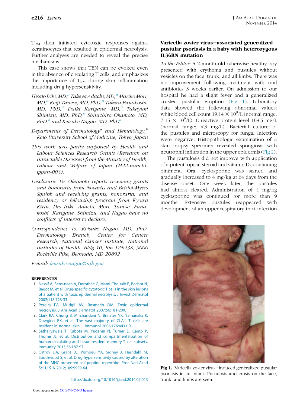Varicella Zoster Virus-Associated Generalized Pustular Psoriasis in A