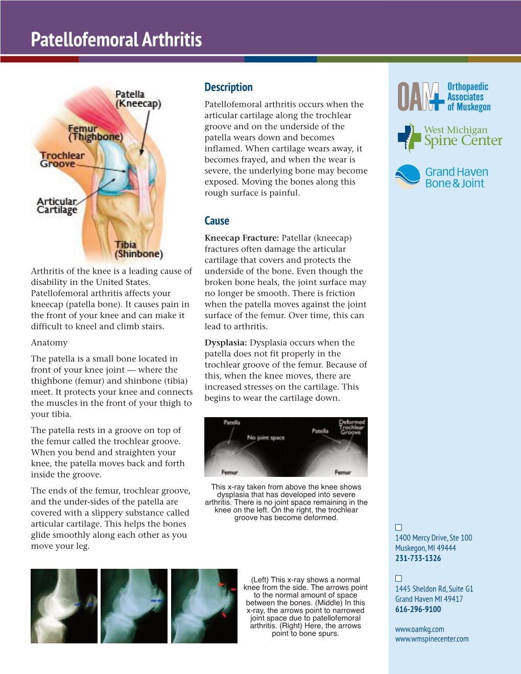 Patellofemoral Arthritis