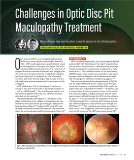 Challenges in Optic Disc Pit Maculopathy Treatment