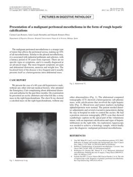 Presentation of a Malignant Peritoneal Mesothelioma in the Form of Rough