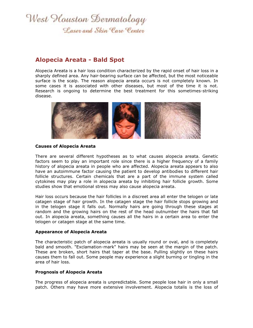 Alopecia Areata - Bald Spot