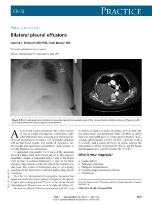 Bilateral Pleural Effusions