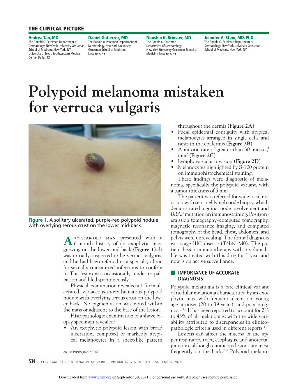 Polypoid Melanoma Mistaken for Verruca Vulgaris