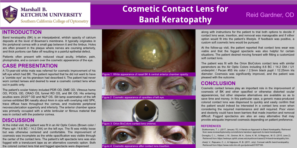 Cosmetic Contact Lens for Band Keratopathy