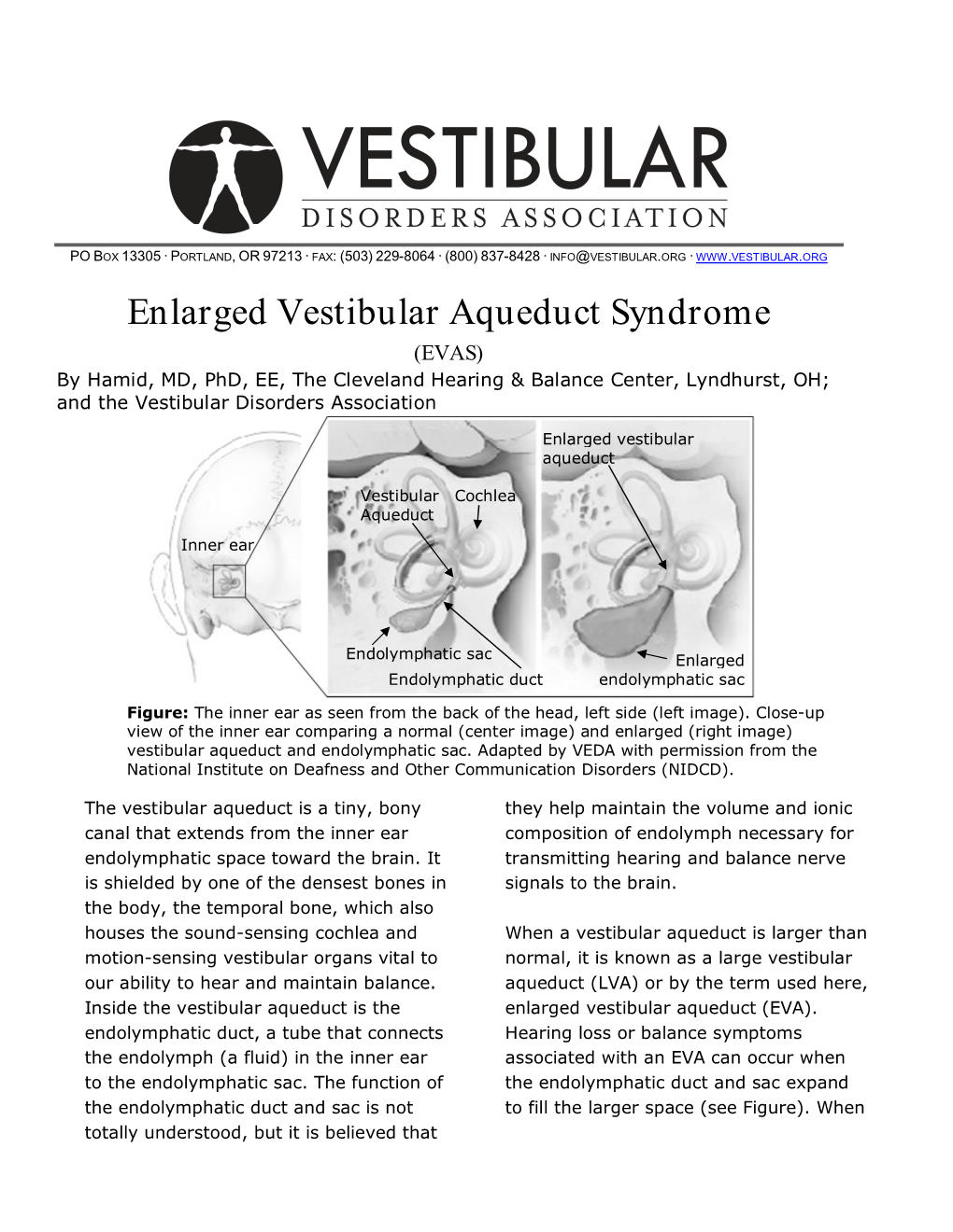 Enlarged Vestibular Aqueduct Syndrome (EVAS) by Hamid, MD, Phd, EE, the Cleveland Hearing & Balance Center, Lyndhurst, OH; and the Vestibular Disorders Association