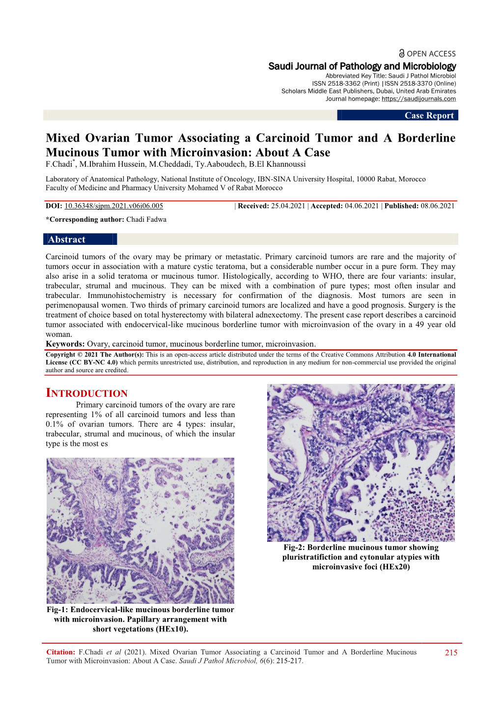 Mixed Ovarian Tumor Associating a Carcinoid Tumor and a Borderline