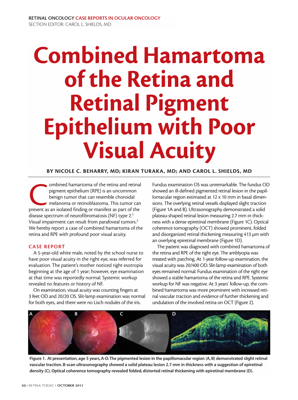 Combined Hamartoma of the Retina and Retinal Pigment Epithelium with Poor Visual Acuity