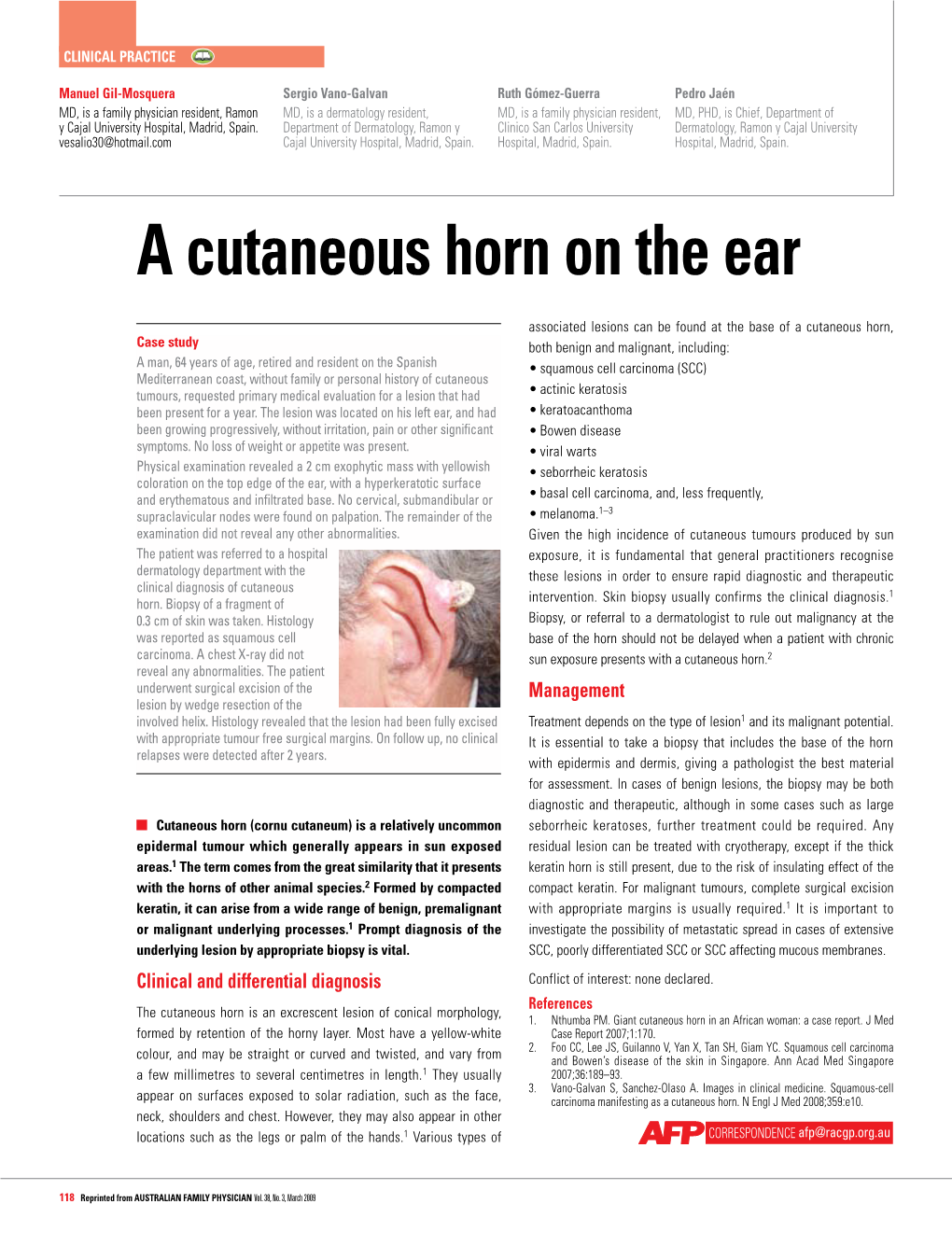 A Cutaneous Horn on the Ear