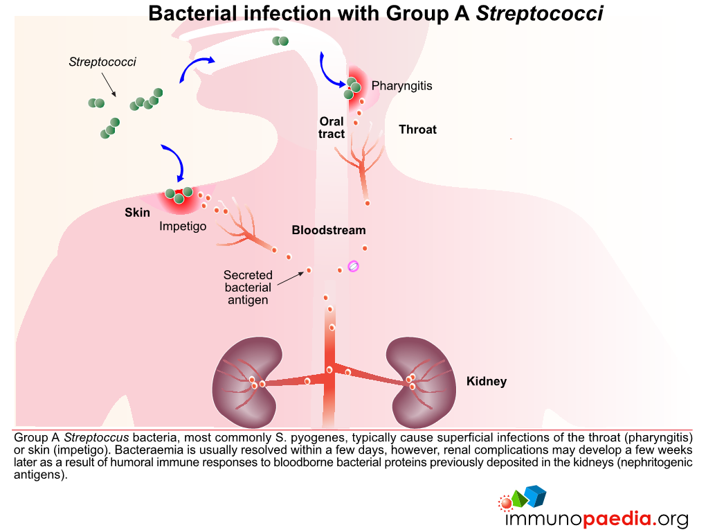 Bacterial Infection with Group a Streptococci