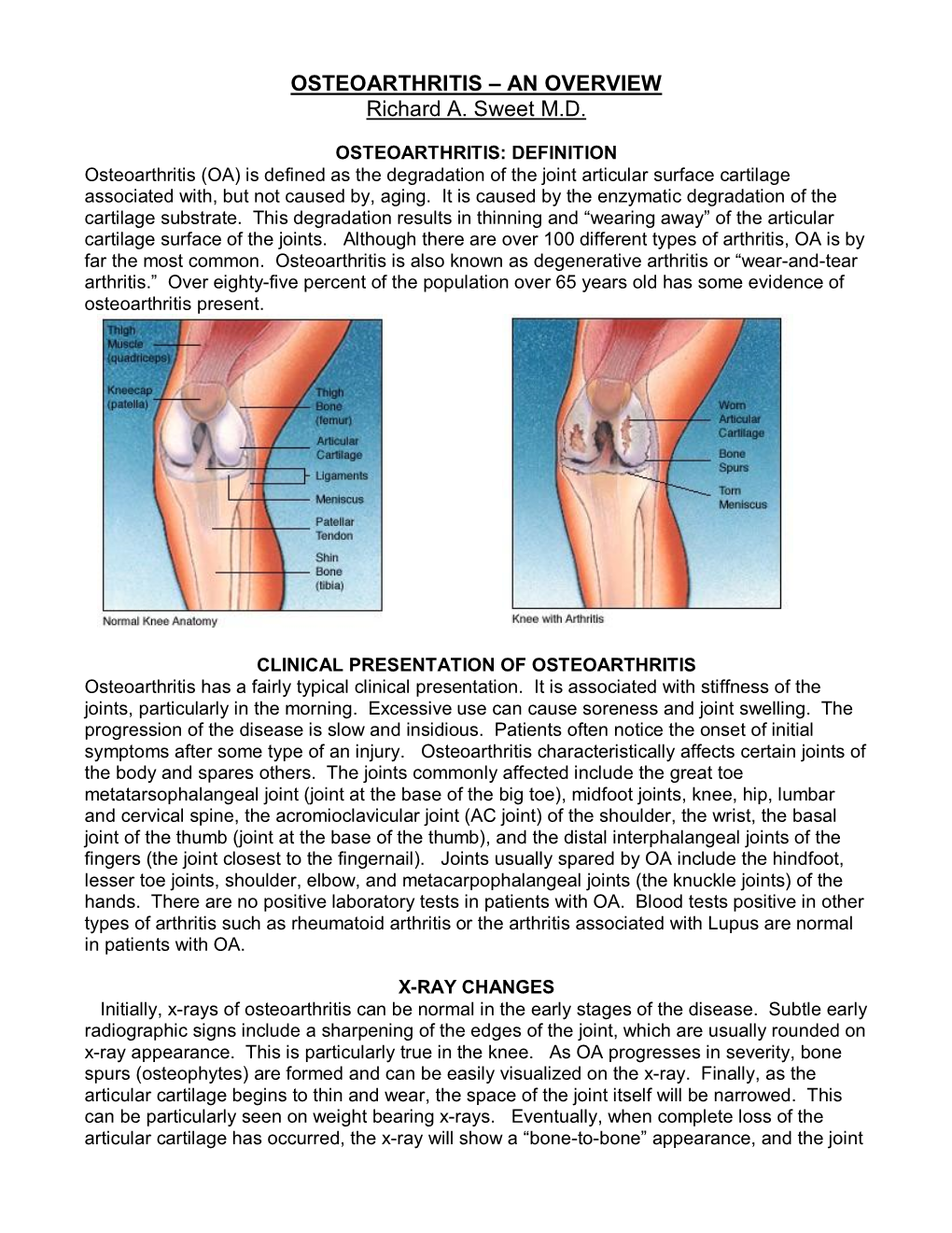 OSTEOARTHRITIS – an OVERVIEW Richard A. Sweet M.D