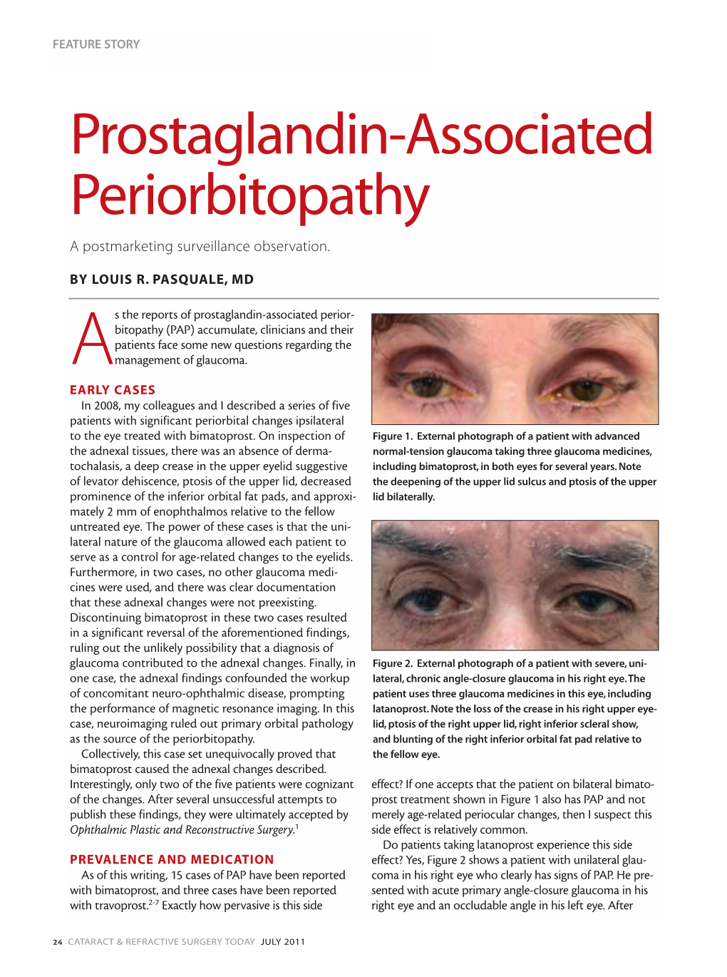 Prostaglandin-Associated Periorbitopathy a Postmarketing Surveillance Observation