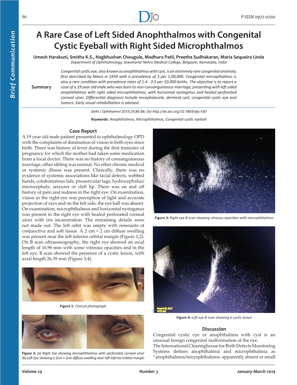 A Rare Case of Left Sided Anophthalmos with Congenital