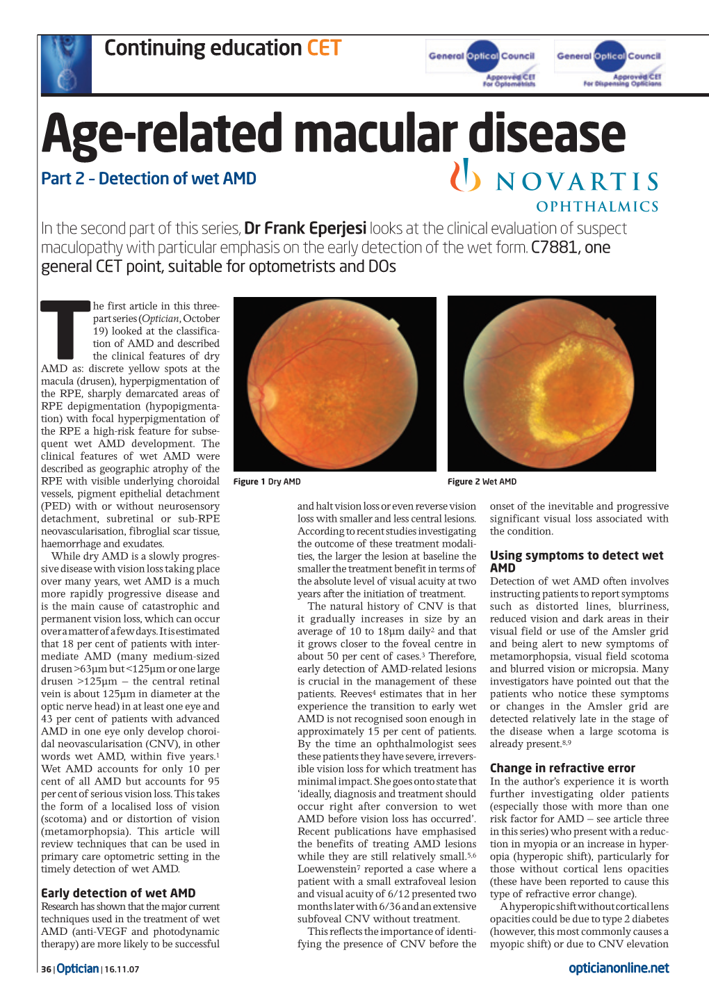 Age-Related Macular Disease Part 2 – Detection of Wet AMD