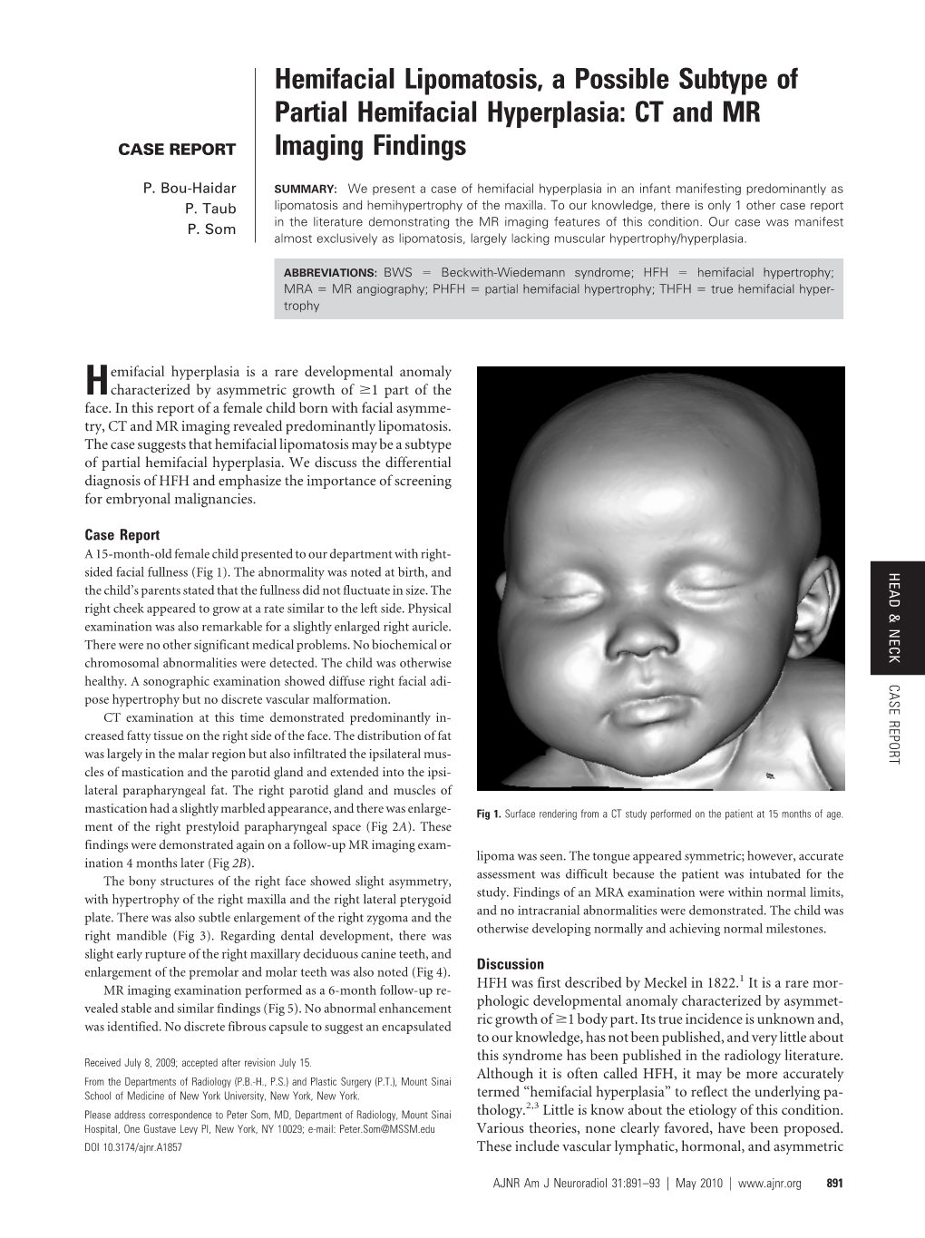 Hemifacial Lipomatosis, a Possible Subtype of Partial Hemifacial Hyperplasia: CT and MR Imaging Findings