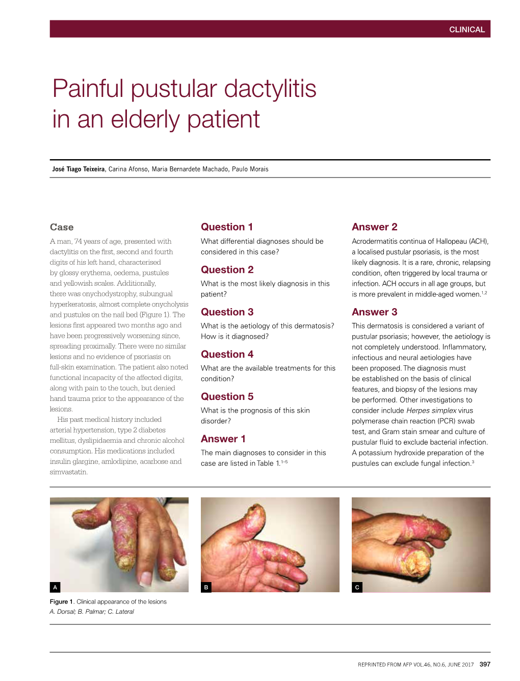 Painful Pustular Dactylitis in an Elderly Patient