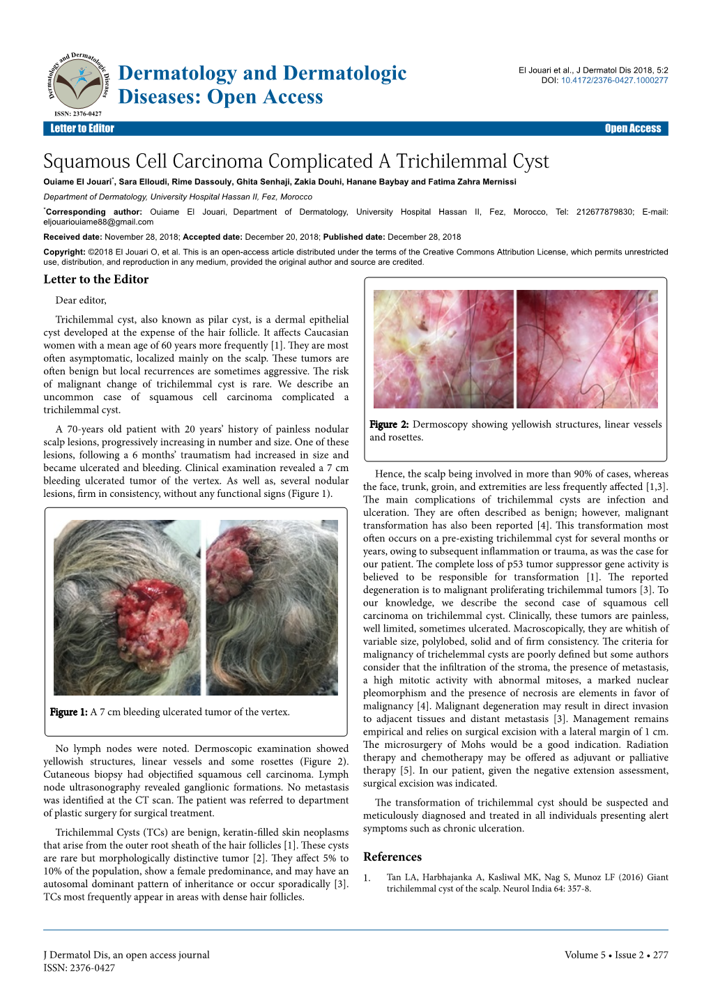 Squamous Cell Carcinoma Complicated a Trichilemmal Cyst