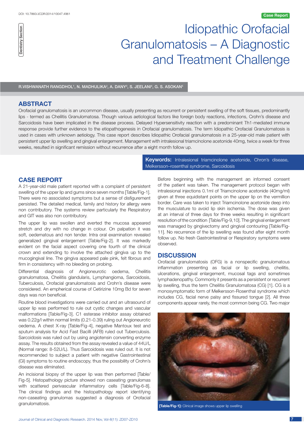 Idiopathic Orofacial Granulomatosis – a Diagnostic D Entistry S Ection and Treatment Challenge