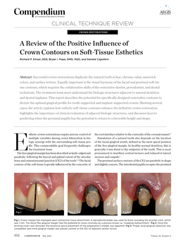 A Review of the Positive Influence of Crown Contours on Soft-Tissue Esthetics Richard P
