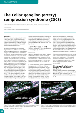The Celiac Ganglion (Artery) Compression Syndrome (CGCS)