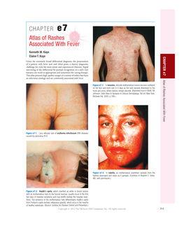 CHAPTER E7 Atlas of Rashes Associated with Fever