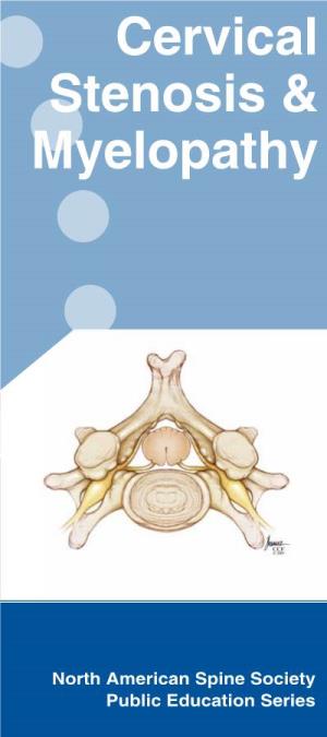 Cervical Stenosis & Myelopathy
