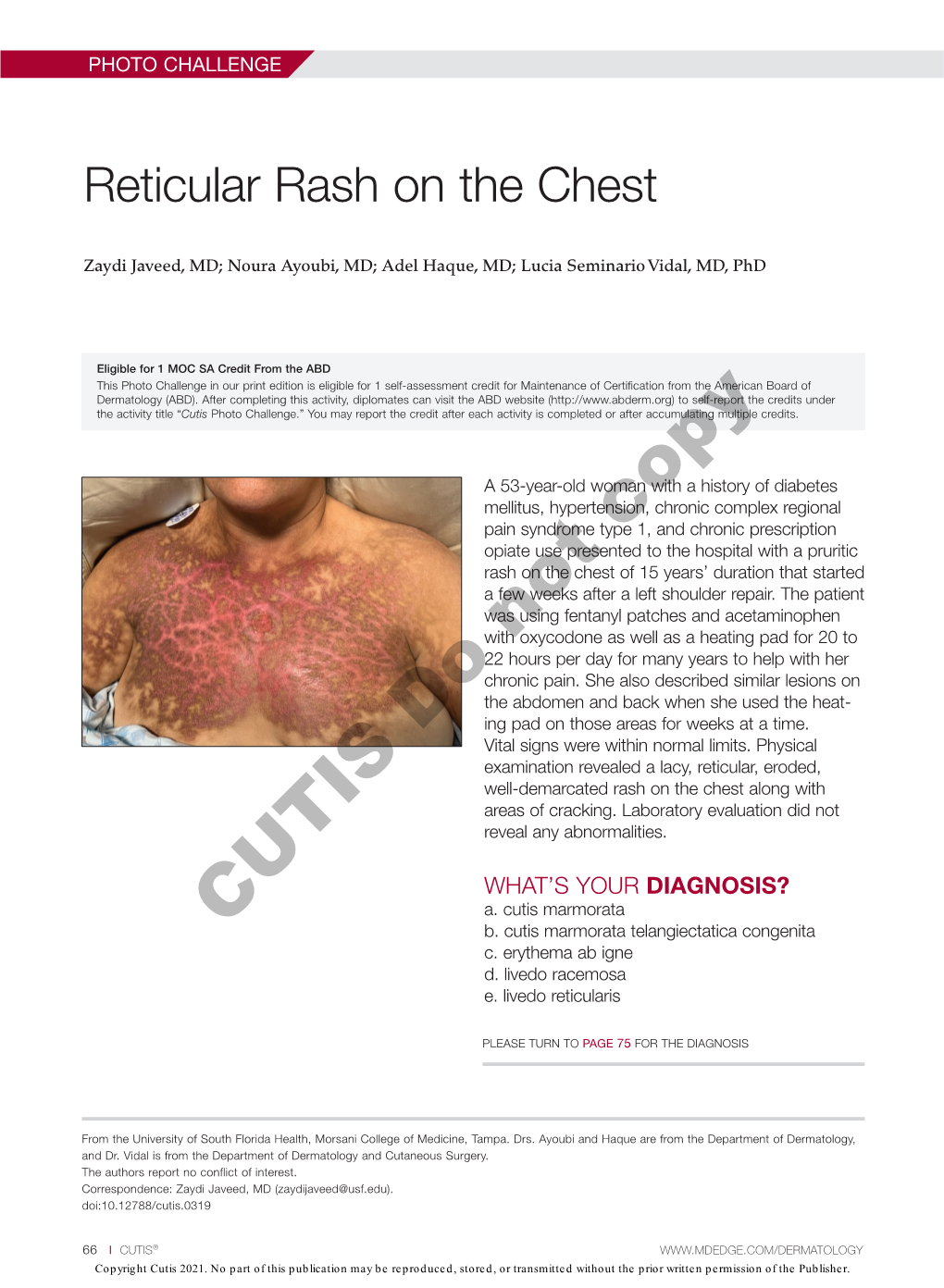 Reticular Rash on the Chest