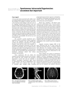 Spontaneous Intracranial Hypotension: Uncommon but Important