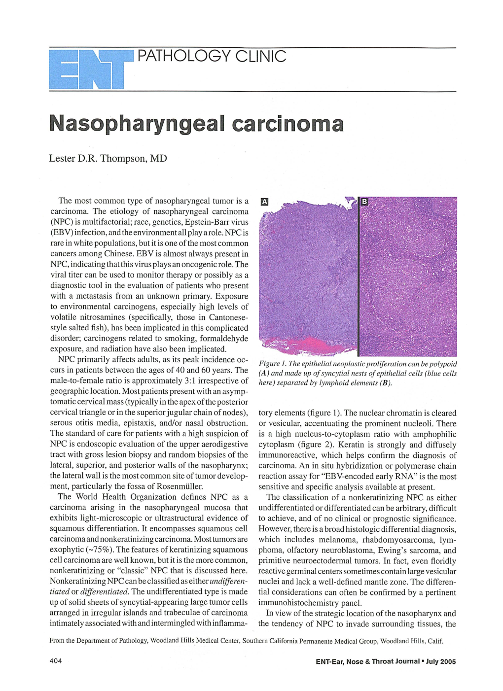 Nasopharyngeal Carcinoma