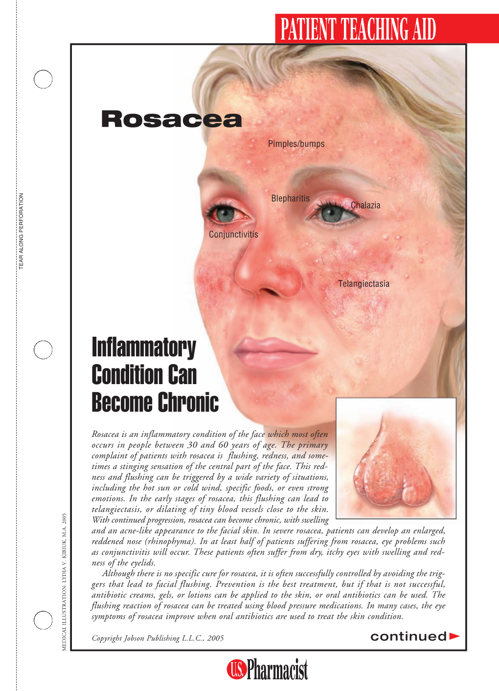 PTA-Rosacea 2/15LS