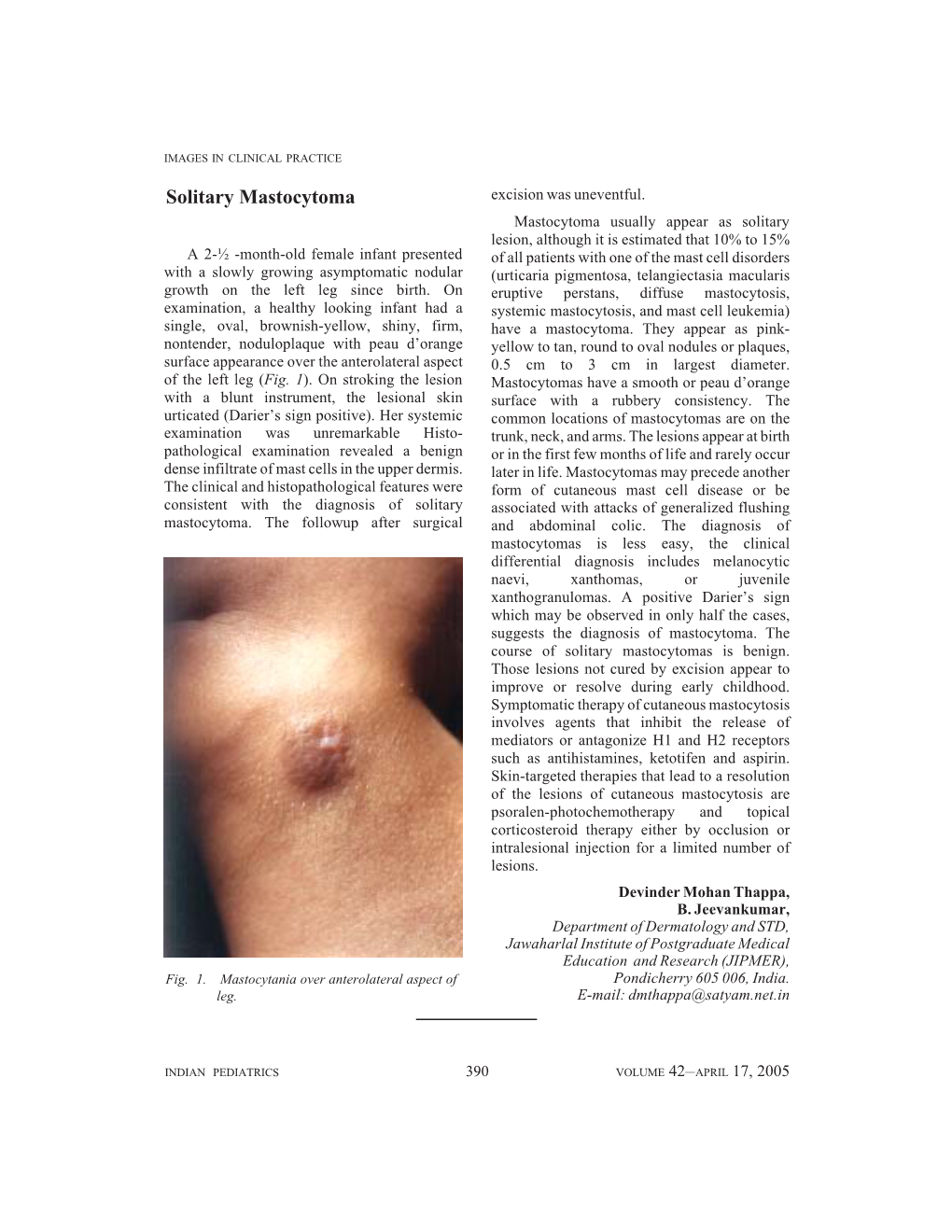 Solitary Mastocytoma Excision Was Uneventful