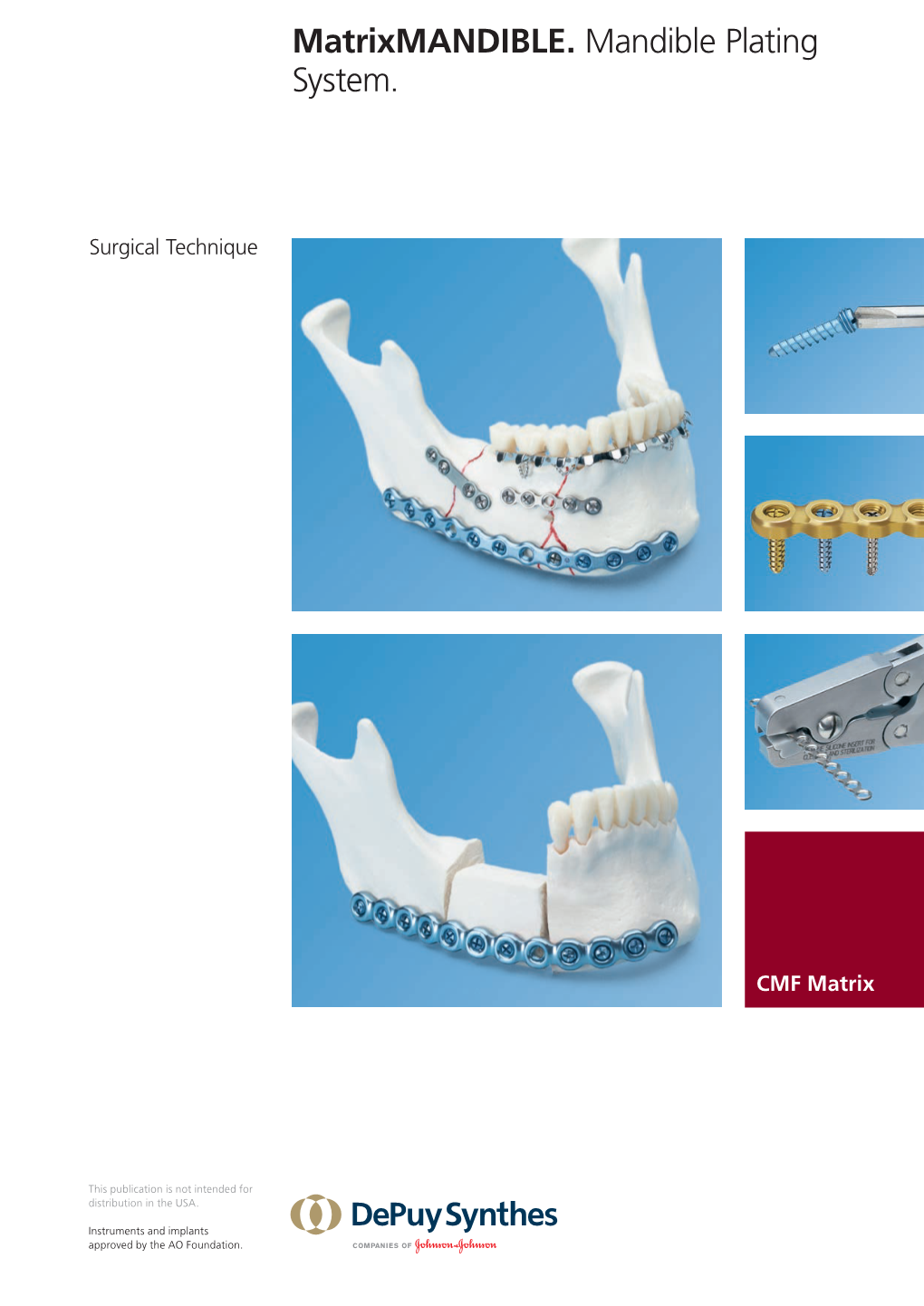 Matrixmandible. Mandible Plating System