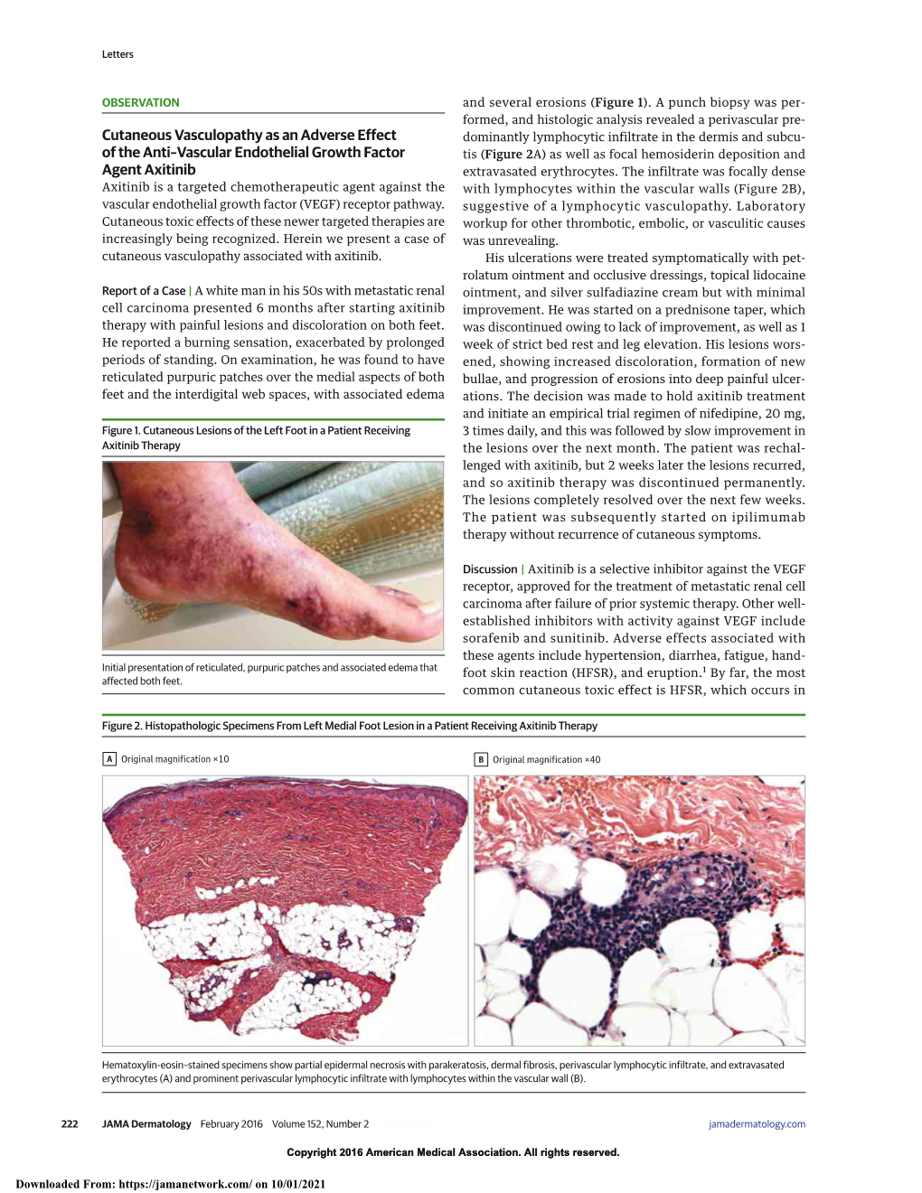 Cutaneous Vasculopathy As an Adverse Effect of the Anti–Vascular