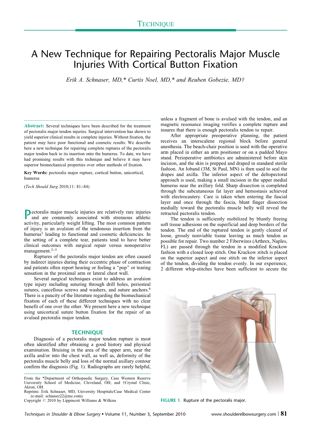 A New Technique for Repairing Pectoralis Major Muscle Injuries with Cortical Button Fixation