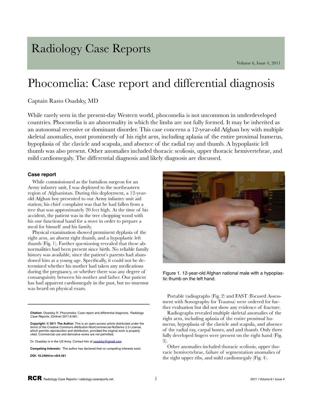 Phocomelia: Case Report and Differential Diagnosis
