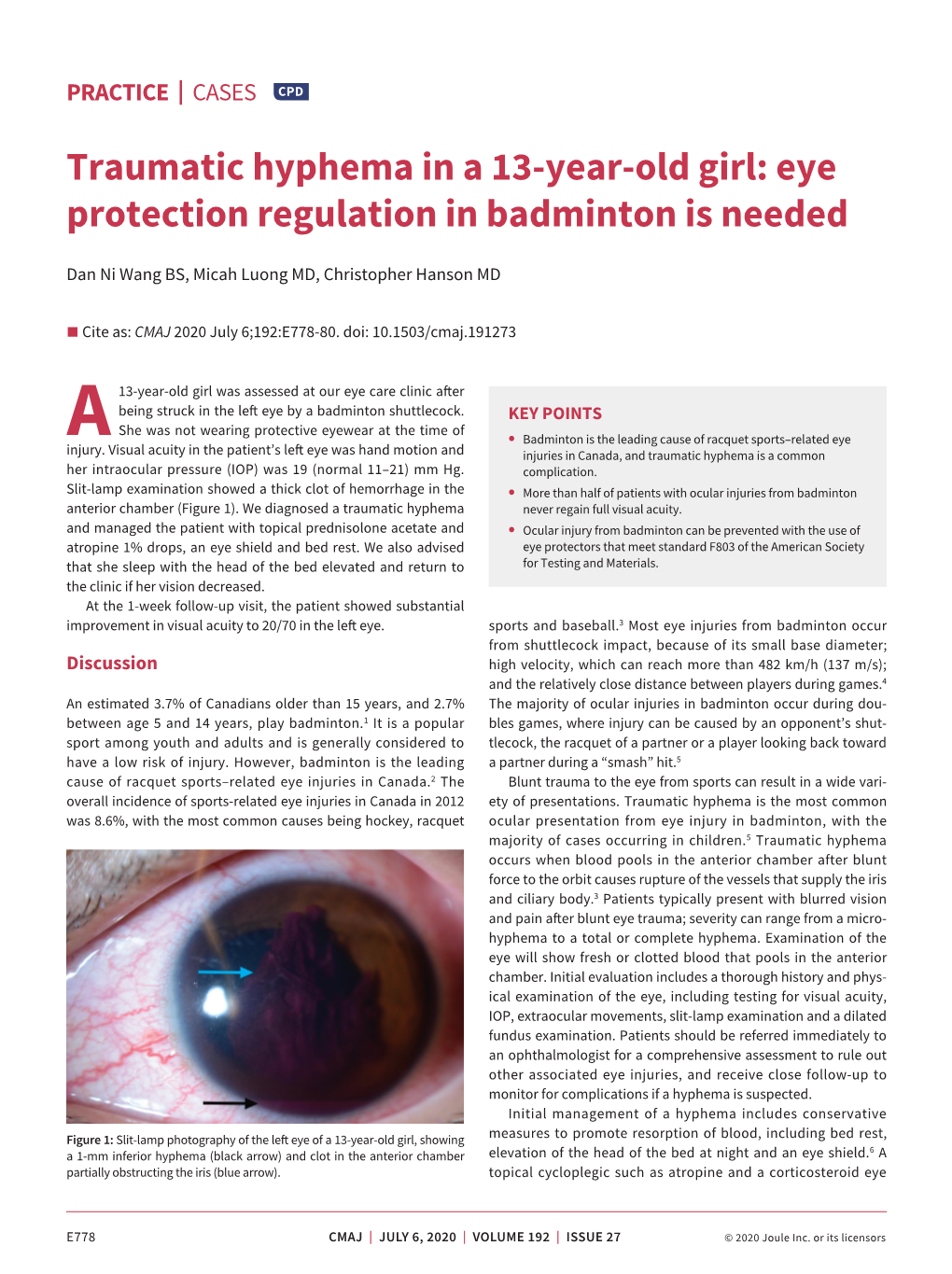 Traumatic Hyphema in a 13-Year-Old Girl: Eye Protection Regulation in Badminton Is Needed