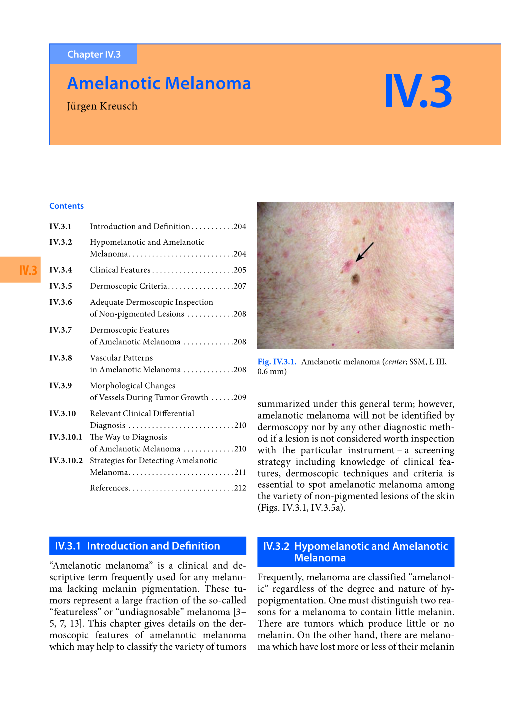 Amelanotic Melanoma Jürgen Kreusch IV.3