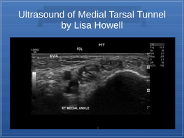 Ultrasound of Medial Tarsal Tunnel by Lisa Howell