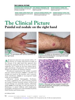 Painful Red Nodule on the Right Hand